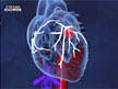 catheter angioplasty coronary