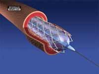 angioplasty stent 2