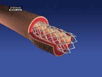 angioplasty stent 3