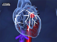 angioplasty catheter 3